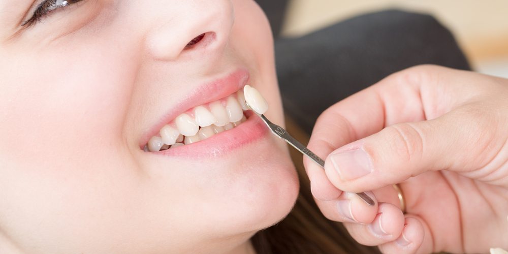 Dental Veneers Wellington | McKeefry Dental Wellington